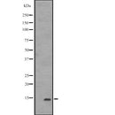 DF2513 at 1/100 staining Human liver cancer tissue by IHC-P. The sample was formaldehyde fixed and a heat mediated antigen retrieval step in citrate buffer was performed. The sample was then blocked and incubated with the antibody for 1.5 hours at 22¡ãC. An HRP conjugated goat anti-rabbit antibody was used as the secondary
