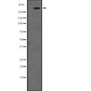 DF2631 at 1/100 staining Human breast cancer tissue by IHC-P. The sample was formaldehyde fixed and a heat mediated antigen retrieval step in citrate buffer was performed. The sample was then blocked and incubated with the antibody for 1.5 hours at 22¡ãC. An HRP conjugated goat anti-rabbit antibody was used as the secondary