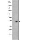 DF2704 at 1/100 staining Human breast cancer tissue by IHC-P. The sample was formaldehyde fixed and a heat mediated antigen retrieval step in citrate buffer was performed. The sample was then blocked and incubated with the antibody for 1.5 hours at 22¡ãC. An HRP conjugated goat anti-rabbit antibody was used as the secondary