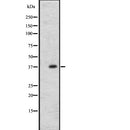 DF2710 at 1/100 staining Human liver cancer tissue by IHC-P. The sample was formaldehyde fixed and a heat mediated antigen retrieval step in citrate buffer was performed. The sample was then blocked and incubated with the antibody for 1.5 hours at 22¡ãC. An HRP conjugated goat anti-rabbit antibody was used as the secondary