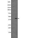 DF2712 at 1/100 staining Human liver cancer tissue by IHC-P. The sample was formaldehyde fixed and a heat mediated antigen retrieval step in citrate buffer was performed. The sample was then blocked and incubated with the antibody for 1.5 hours at 22¡ãC. An HRP conjugated goat anti-rabbit antibody was used as the secondary