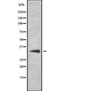 DF2717 at 1/100 staining Human liver cancer tissue by IHC-P. The sample was formaldehyde fixed and a heat mediated antigen retrieval step in citrate buffer was performed. The sample was then blocked and incubated with the antibody for 1.5 hours at 22¡ãC. An HRP conjugated goat anti-rabbit antibody was used as the secondary