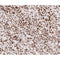 AF0145 at 1/200 staining human Breast cancer tissue sections by IHC-P. The tissue was formaldehyde fixed and a heat mediated antigen retrieval step in citrate buffer was performed. The tissue was then blocked and incubated with the antibody for 1.5 hours at 22¡ãC. An HRP conjugated goat anti-rabbit antibody was used as the secondary