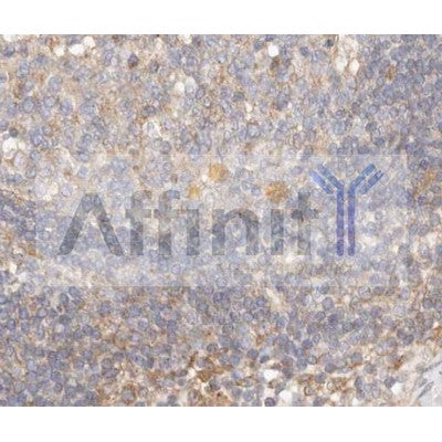 AF0155 at 1/50 staining human colon cancer tissue sections by IHC-P. The tissue was formaldehyde fixed and a heat mediated antigen retrieval step in citrate buffer was performed. The tissue was then blocked and incubated with the antibody for 1.5 hours at 22¡ãC. An HRP conjugated goat anti-rabbit antibody was used as the secondary