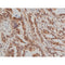 AF0016 at 1/200 staining human lung cancer tissue sections by IHC-P. The tissue was formaldehyde fixed and a heat mediated antigen retrieval step in citrate buffer was performed. The tissue was then blocked and incubated with the antibody for 1.5 hours at 22¡ãC. An HRP conjugated goat anti-rabbit antibody was used as the secondary