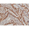 AF0016 at 1/200 staining human lung cancer tissue sections by IHC-P. The tissue was formaldehyde fixed and a heat mediated antigen retrieval step in citrate buffer was performed. The tissue was then blocked and incubated with the antibody for 1.5 hours at 22¡ãC. An HRP conjugated goat anti-rabbit antibody was used as the secondary