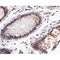 AF0037 at 1/200 staining human colon carcinoma tissue sections by IHC-P. The tissue was formaldehyde fixed and a heat mediated antigen retrieval step in citrate buffer was performed. The tissue was then blocked and incubated with the antibody for 1.5 hours at 22¡ãC. An HRP conjugated goat anti-rabbit antibody was used as the secondary