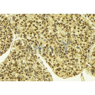 AF0004 at 1/100 staining Human breast cancer tissue by IHC-P. The sample was formaldehyde fixed and a heat mediated antigen retrieval step in citrate buffer was performed. The sample was then blocked and incubated with the antibody for 1.5 hours at 22¡ãC. An HRP conjugated goat anti-rabbit antibody was used as the secondary