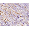 AF0161 at 1/100 staining human breast carcinoma tissue sections by IHC-P. The tissue was formaldehyde fixed and a heat mediated antigen retrieval step in citrate buffer was performed. The tissue was then blocked and incubated with the antibody for 1.5 hours at 22¡ãC. An HRP conjugated goat anti-rabbit antibody was used as the secondary