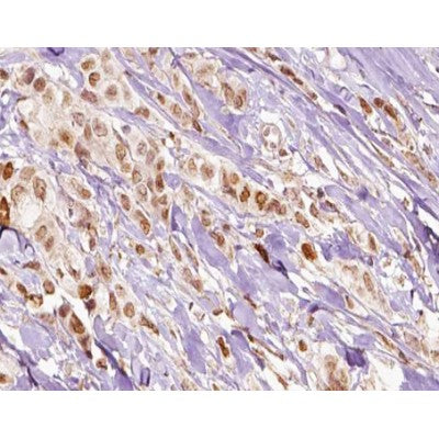 AF0161 at 1/100 staining human breast carcinoma tissue sections by IHC-P. The tissue was formaldehyde fixed and a heat mediated antigen retrieval step in citrate buffer was performed. The tissue was then blocked and incubated with the antibody for 1.5 hours at 22¡ãC. An HRP conjugated goat anti-rabbit antibody was used as the secondary