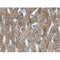 AF0211 at 1/100 staining human liver carcinoma tissue sections by IHC-P. The tissue was   formaldehyde fixed and a heat mediated antigen retrieval step in citrate buffer was   performed. The tissue was then blocked and incubated with the antibody for 1.5 hours at 22  ¡ãC. An HRP conjugated goat anti-rabbit antibody was used as the secondary