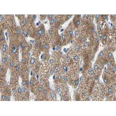 AF0211 at 1/100 staining human liver carcinoma tissue sections by IHC-P. The tissue was   formaldehyde fixed and a heat mediated antigen retrieval step in citrate buffer was   performed. The tissue was then blocked and incubated with the antibody for 1.5 hours at 22  ¡ãC. An HRP conjugated goat anti-rabbit antibody was used as the secondary