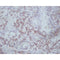 AF0212 at 1/200 staining human Oral squamous cell carcinoma sections by IHC-P. The tissue was formaldehyde fixed and a heat mediated antigen retrieval step in citrate buffer was performed. The tissue was then blocked and incubated with the antibody for 1.5 hours at 22¡ãC. An HRP conjugated goat anti-rabbit antibody was used as the secondary