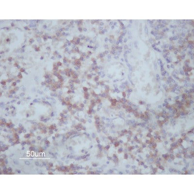 AF0212 at 1/200 staining human Oral squamous cell carcinoma sections by IHC-P. The tissue was formaldehyde fixed and a heat mediated antigen retrieval step in citrate buffer was performed. The tissue was then blocked and incubated with the antibody for 1.5 hours at 22¡ãC. An HRP conjugated goat anti-rabbit antibody was used as the secondary