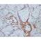 AF0212 at 1/200 staining human Oral squamous cell carcinoma sections by IHC-P. The tissue was formaldehyde fixed and a heat mediated antigen retrieval step in citrate buffer was performed. The tissue was then blocked and incubated with the antibody for 1.5 hours at 22¡ãC. An HRP conjugated goat anti-rabbit antibody was used as the secondary