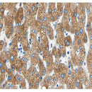 AF0215 at 1/100 staining human liver carcinoma tissue sections by IHC-P. The tissue was   formaldehyde fixed and a heat mediated antigen retrieval step in citrate buffer was   performed. The tissue was then blocked and incubated with the antibody for 1.5 hours at 22  ¡ãC. An HRP conjugated goat anti-rabbit antibody was used as the secondary