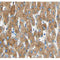 AF0215 at 1/100 staining human liver carcinoma tissue sections by IHC-P. The tissue was   formaldehyde fixed and a heat mediated antigen retrieval step in citrate buffer was   performed. The tissue was then blocked and incubated with the antibody for 1.5 hours at 22  ¡ãC. An HRP conjugated goat anti-rabbit antibody was used as the secondary