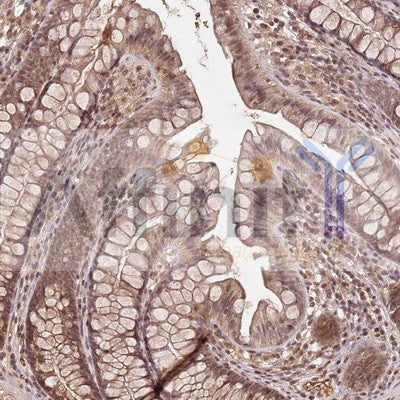 AF0134 at 1/100 staining human colon cancer tissues sections by IHC-P. The tissue was formaldehyde fixed and a heat mediated antigen retrieval step in citrate buffer was performed. The tissue was then blocked and incubated with the antibody for 1.5 hours 