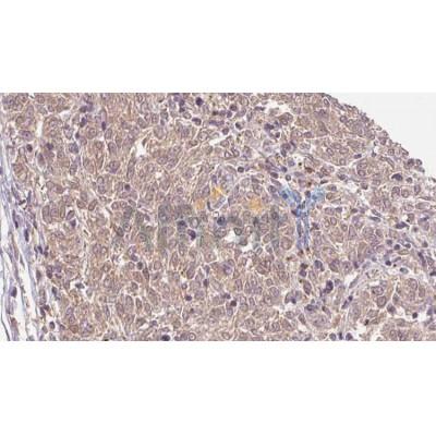 AF0134 at 1/100 staining Human Melanoma tissue by IHC-P. The sample was formaldehyde fixed and a heat mediated antigen retrieval step in citrate buffer was performed. The sample was then blocked and incubated with the antibody for 1.5 hours at 22¡ãC. An HRP conjugated goat anti-rabbit antibody was used as the secondary