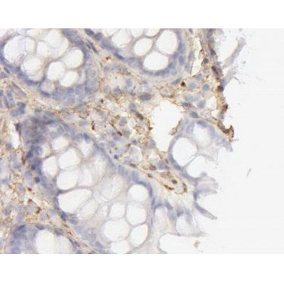 AF0510 at 1/100 staining human colon cancer tissues sections by IHC-P. The tissue was formaldehyde fixed and a heat mediated antigen retrieval step in citrate buffer was performed. The tissue was then blocked and incubated with the antibody for 1.5 hours 