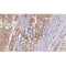 AF0510 at 1/100 staining Human Melanoma tissue by IHC-P. The sample was formaldehyde fixed and a heat mediated antigen retrieval step in citrate buffer was performed. The sample was then blocked and incubated with the antibody for 1.5 hours at 22¡ãC. An HRP conjugated goat anti-rabbit antibody was used as the secondary