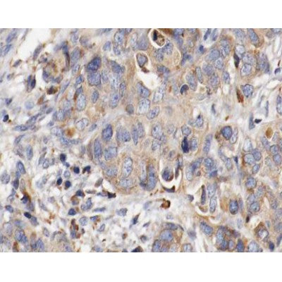AF0429 at 1/100 staining human ovarian cancer tissue sections by IHC-P. The tissue was formaldehyde fixed and a heat mediated antigen retrieval step in citrate buffer was performed. The tissue was then blocked and incubated with the antibody for 1.5 hours at 22¡ãC. An HRP conjugated goat anti-rabbit antibody was used as the secondary