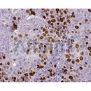 Tumour tissue KI67 antibody used at 1/200 on formalin-fixed paraffin embedded tissue.This image is a courtesy of Anonymous review