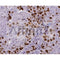Tumour tissue KI67 antibody used at 1/200 on formalin-fixed paraffin embedded tissue.This image is a courtesy of Anonymous review