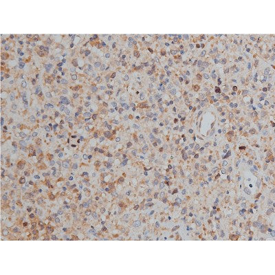 AF0198 at 1/50 staining human lymphoma tissue sections by IHC-P. The tissue was formaldehyde fixed and a heat mediated antigen retrieval step in citrate buffer was performed. The tissue was then blocked and incubated with the antibody for 1.5 hours at 22¡ãC. An HRP conjugated goat anti-rabbit antibody was used as the secondary