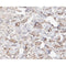 AF0505 at 1/100 staining human Breast cancer tissue sections by IHC-P. The tissue was formaldehyde fixed and a heat mediated antigen retrieval step in citrate buffer was performed. The tissue was then blocked and incubated with the antibody for 1.5 hours at 22¡ãC. An HRP conjugated goat anti-rabbit antibody was used as the secondary