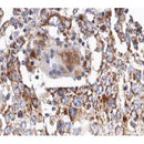 AF0260 at 1/100 staining human lung carcinoma tissue sections by IHC-P. The tissue was formaldehyde fixed and a heat mediated antigen retrieval step in citrate buffer was performed. The tissue was then blocked and incubated with the antibody for 1.5 hours at 22¡ãC. An HRP conjugated goat anti-rabbit antibody was used as the secondary