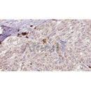 AF0220 at 1/100 staining Human Melanoma tissue by IHC-P. The sample was formaldehyde fixed and a heat mediated antigen retrieval step in citrate buffer was performed. The sample was then blocked and incubated with the antibody for 1.5 hours at 22¡ãC. An HRP conjugated goat anti-rabbit antibody was used as the secondary