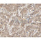 IHC analysis of breast cancer tissue, using NEDD8 Antibody at 1/100