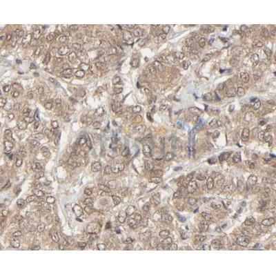 IHC analysis of breast cancer tissue, using NEDD8 Antibody at 1/100