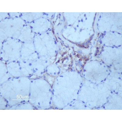 AF0428 at 1/200 staining human Oral squamous cell carcinoma sections by IHC-P. The tissue was formaldehyde fixed and a heat mediated antigen retrieval step in citrate buffer was performed. The tissue was then blocked and incubated with the antibody for 1.5 hours at 22¡ãC. An HRP conjugated goat anti-rabbit antibody was used as the secondary