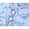 AF0428 at 1/200 staining human Oral squamous cell carcinoma sections by IHC-P. The tissue was formaldehyde fixed and a heat mediated antigen retrieval step in citrate buffer was performed. The tissue was then blocked and incubated with the antibody for 1.5 hours at 22¡ãC. An HRP conjugated goat anti-rabbit antibody was used as the secondary