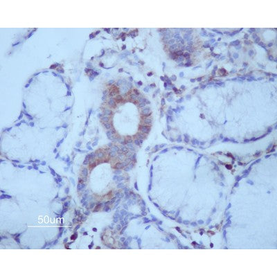AF0428 at 1/200 staining human Oral squamous cell carcinoma sections by IHC-P. The tissue was formaldehyde fixed and a heat mediated antigen retrieval step in citrate buffer was performed. The tissue was then blocked and incubated with the antibody for 1.5 hours at 22¡ãC. An HRP conjugated goat anti-rabbit antibody was used as the secondary
