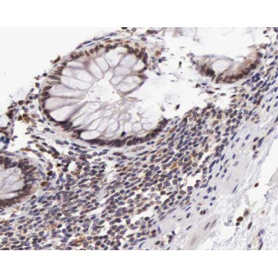 AF0164 at 1/100 staining human colon carcinoma tissue sections by IHC-P. The tissue was formaldehyde fixed and a heat mediated antigen retrieval step in citrate buffer was performed. The tissue was then blocked and incubated with the antibody for 1.5 hours at 22¡ãC. An HRP conjugated goat anti-rabbit antibody was used as the secondary