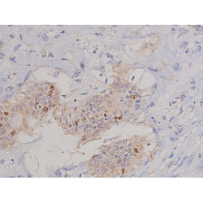 AF0198 at 1/200 staining Human colon cancer tissue sections by IHC-P. The tissue was formaldehyde fixed and a heat mediated antigen retrieval step in citrate buffer was performed. The tissue was then blocked and incubated with the antibody for 1.5 hours at 22¡ãC. An HRP conjugated goat anti-rabbit antibody was used as the secondary