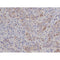 AF0198 at 1/200 staining Human ganstric cancer tissue sections by IHC-P. The tissue was formaldehyde fixed and a heat mediated antigen retrieval step in citrate buffer was performed. The tissue was then blocked and incubated with the antibody for 1.5 hours at 22¡ãC. An HRP conjugated goat anti-rabbit antibody was used as the secondary