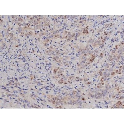 AF0198 at 1/200 staining Human ganstric cancer tissue sections by IHC-P. The tissue was formaldehyde fixed and a heat mediated antigen retrieval step in citrate buffer was performed. The tissue was then blocked and incubated with the antibody for 1.5 hours at 22¡ãC. An HRP conjugated goat anti-rabbit antibody was used as the secondary