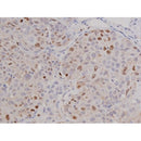 AF0198 at 1/200 staining Human lung cancer tissue sections by IHC-P. The tissue was formaldehyde fixed and a heat mediated antigen retrieval step in citrate buffer was performed. The tissue was then blocked and incubated with the antibody for 1.5 hours at 22¡ãC. An HRP conjugated goat anti-rabbit antibody was used as the secondary