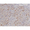 AF0198 at 1/200 staining Human lung cancer tissue sections by IHC-P. The tissue was formaldehyde fixed and a heat mediated antigen retrieval step in citrate buffer was performed. The tissue was then blocked and incubated with the antibody for 1.5 hours at 22¡ãC. An HRP conjugated goat anti-rabbit antibody was used as the secondary