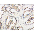 AF0239 at 1/100 staining human breast carcinoma tissue sections by IHC-P. The tissue was formaldehyde fixed and a heat mediated antigen retrieval step in citrate buffer was performed. The tissue was then blocked and incubated with the antibody for 1.5 hours at 22¡ãC. An HRP conjugated goat anti-rabbit antibody was used as the secondary