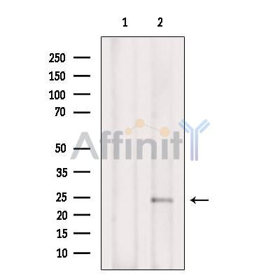 AF2423 at 1/100 staining Human thyroid cancer tissue by IHC-P. The sample was formaldehyde fixed and a heat mediated antigen retrieval step in citrate buffer was performed. The sample was then blocked and incubated with the antibody for 1.5 hours at 22¡ãC. An HRP conjugated goat anti-rabbit antibody was used as the secondary