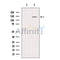 DF12281 at 1/100 staining Human lymph cancer tissue by IHC-P. The sample was formaldehyde fixed and a heat mediated antigen retrieval step in citrate buffer was performed. The sample was then blocked and incubated with the antibody for 1.5 hours at 22¡ãC. An HRP conjugated goat anti-rabbit antibody was used as the secondary