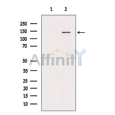 DF12281 at 1/100 staining Human lymph cancer tissue by IHC-P. The sample was formaldehyde fixed and a heat mediated antigen retrieval step in citrate buffer was performed. The sample was then blocked and incubated with the antibody for 1.5 hours at 22¡ãC. An HRP conjugated goat anti-rabbit antibody was used as the secondary