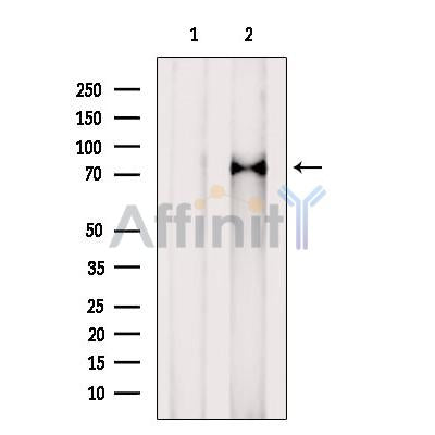 DF12294 at 1/100 staining Human lymph cancer tissue by IHC-P. The sample was formaldehyde fixed and a heat mediated antigen retrieval step in citrate buffer was performed. The sample was then blocked and incubated with the antibody for 1.5 hours at 22¡ãC. An HRP conjugated goat anti-rabbit antibody was used as the secondary