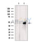 DF12332 at 1/100 staining Human lymph cancer tissue by IHC-P. The sample was formaldehyde fixed and a heat mediated antigen retrieval step in citrate buffer was performed. The sample was then blocked and incubated with the antibody for 1.5 hours at 22¡ãC. An HRP conjugated goat anti-rabbit antibody was used as the secondary