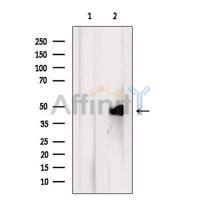 DF12332 at 1/100 staining Human lymph cancer tissue by IHC-P. The sample was formaldehyde fixed and a heat mediated antigen retrieval step in citrate buffer was performed. The sample was then blocked and incubated with the antibody for 1.5 hours at 22¡ãC. An HRP conjugated goat anti-rabbit antibody was used as the secondary